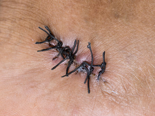  Surgical Scar 