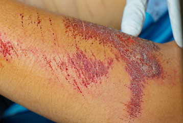 Leg abrasion wound accident.