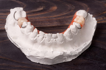 plaster cast of teeth with removable partial denture on a dark wooden background