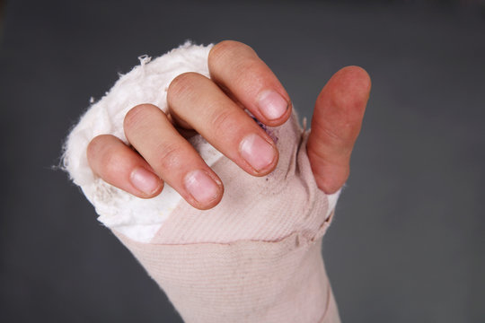 Bandaged Broken Hand