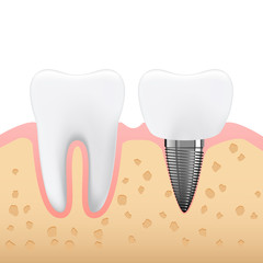 Schematic illustration of dental prosthetics, denture, side view