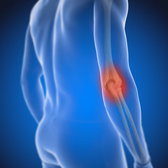 Fototapeta premium Arthrose im Ellbogengelenk