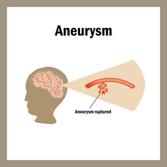 Break anevrizmy.Krovoizliyanie brain. Stroke, atherosclerosis, aneurysm. Cholesterol plaques. Infographics. Vector illustration