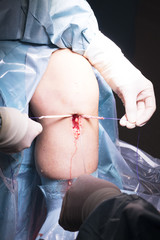 Surgical operation knee surgery