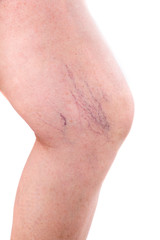 leg with spider veins
