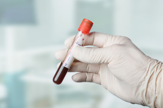 Hand mit Handschuh hält eine Blutprobe mit Labor unscharf im Hintergrund