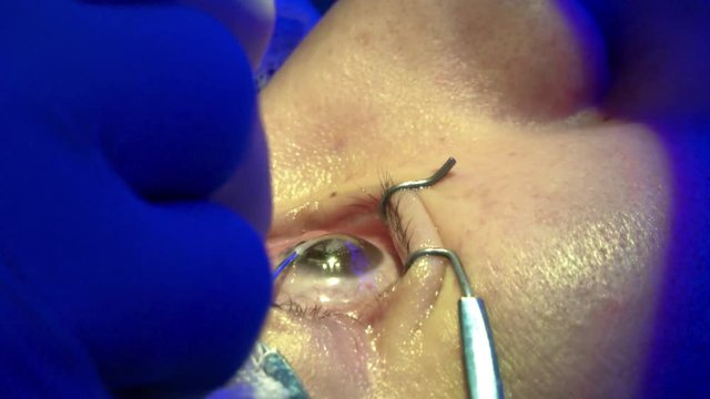 Laser treatment of cataracts