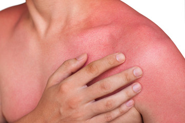 A man with reddened itchy skin after sunburn. Skin care and protection from the sun's ultraviolet rays. © Dimid