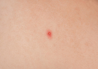Fototapeta premium Big red pustules on the skin close-up. Beauty and skin care.