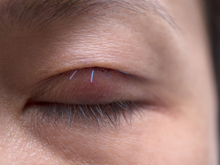 Fototapeta na wymiar Closed up of doubl layer eyelid surgery