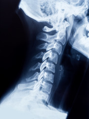 Röntgen Bild - X-Ray Schädel und Halswirbelsäule