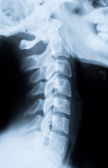 Röntgen Bild - X-Ray Schädel und Halswirbelsäule