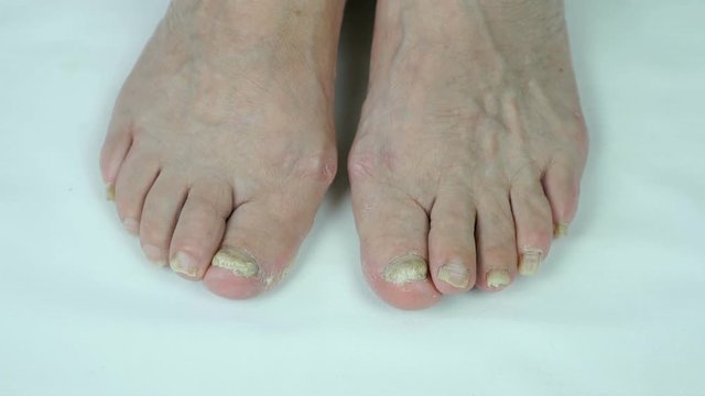 Onychomycosis fungal nail infection of foot