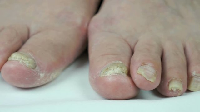 Onychomycosis. Fungal infection of nails of old woman's feet