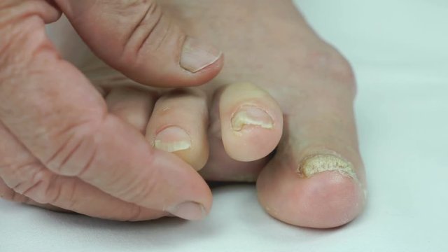 Onychomycosis. Fungal infection of nails of old woman's feet