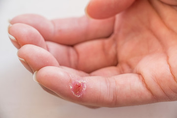 Closed-up of a wound on finger