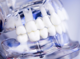 Dentists dental teeth implant