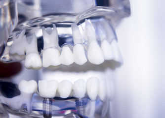 Dentists dental teeth implant