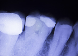 Tooth filling dental xray