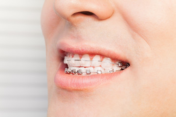 Man's smile with dental braces on teeth
