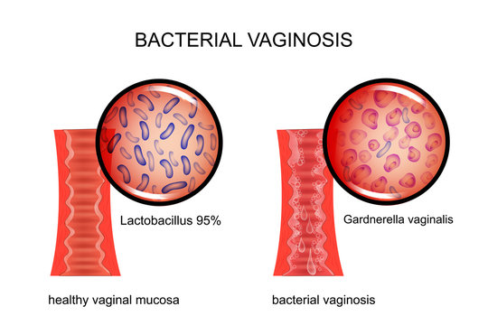bacterial vaginosis. the vagina and the causative agent