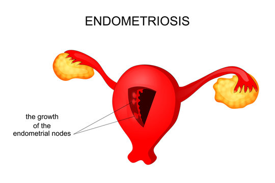 the uterus affected by endometriosis
