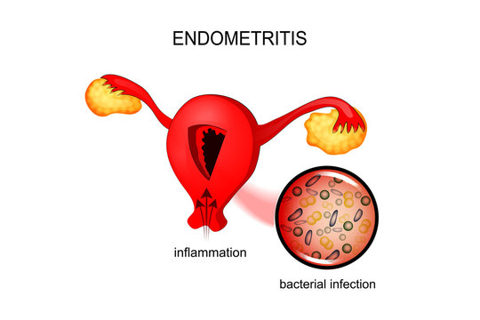 the uterus affected by endometriosis