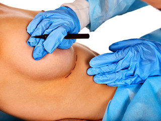 Breast surgery of body part. Implants for surgery augmentation . Doctor makes dotted line on female...
