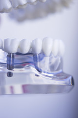 Dentists dental teeth implant