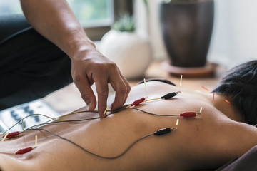 Therapist Giving acupuncture Treatment To a Japanese Woman - 133528384