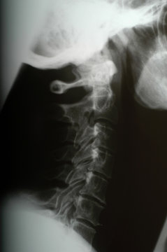 X-ray, spinal solumn (model-released)