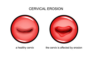 the cervix is affected by erosion - obrazy, fototapety, plakaty