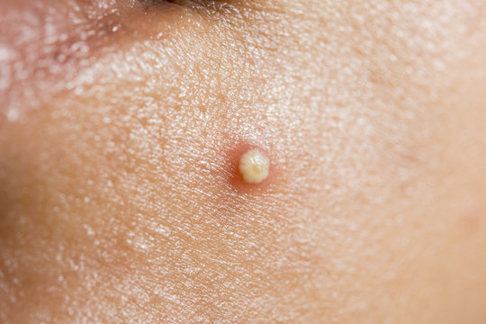 closeup for acne on chin