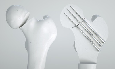 Fracture of the femur - Treatment with screws - 3D Rendering