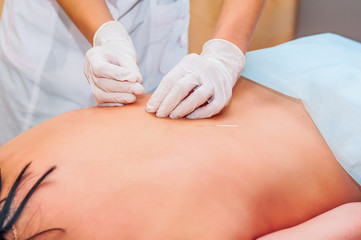 Close up view of woman holding a needle in an acupuncture therapy