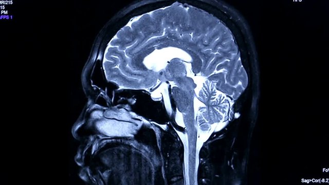MRI brain scan, Side view
