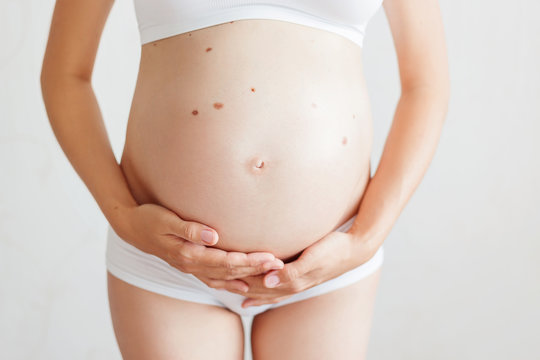 Pregnant woman with many birthmarks (nevus) in white underwear. Young woman expecting a baby.