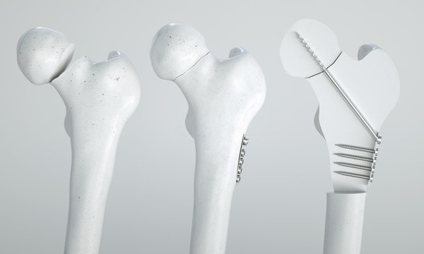 Fracture of the femur - Treatment with screws - 3D Rendering