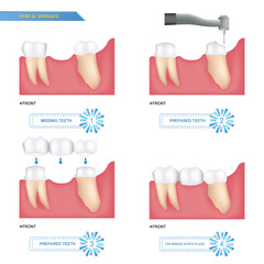 infographics dental bridge used to cover a missing tooth