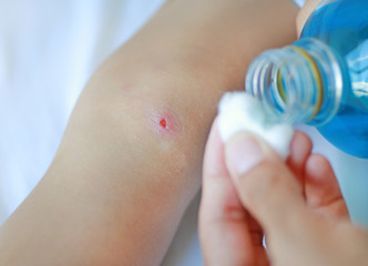 Close up wound on child knee. Mother dressing child's knee.