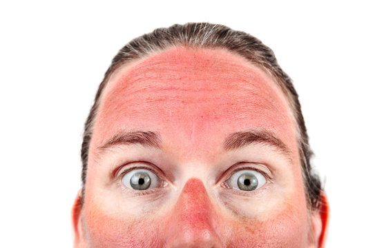 Woman with Sunglasess sunburn