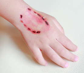 Sticker wound and blood from a bite human teeth on child hand, Dress up tattoos, Halloween concept.