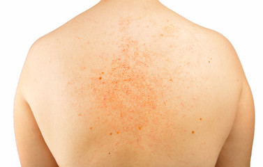 eczema on my back