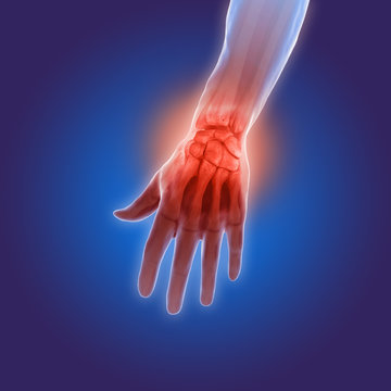 3d illustration of arthritis pain in hands