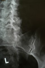 X-ray (model-released)