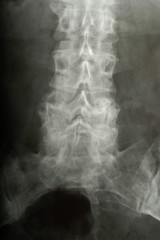 X-ray of a woman, spinal cord of a woman, 40-50 years, vertebrae