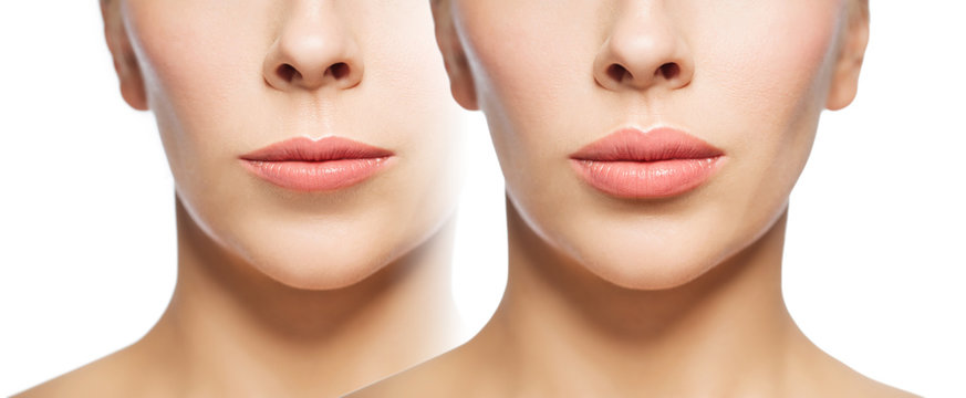 woman before and after lip fillers