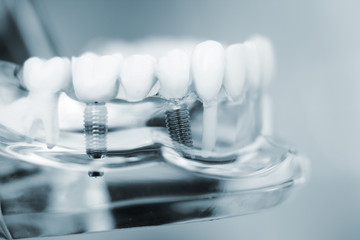 Dentists dental teeth implant - obrazy, fototapety, plakaty