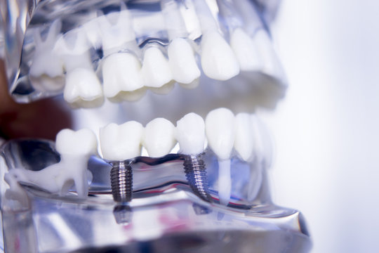Dentists dental teeth implant