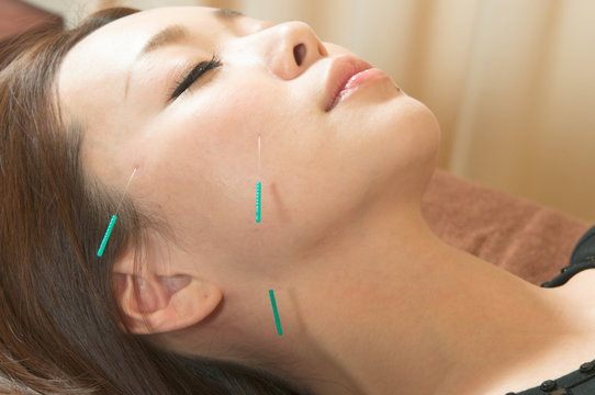 日本人女性の顔に美容鍼
